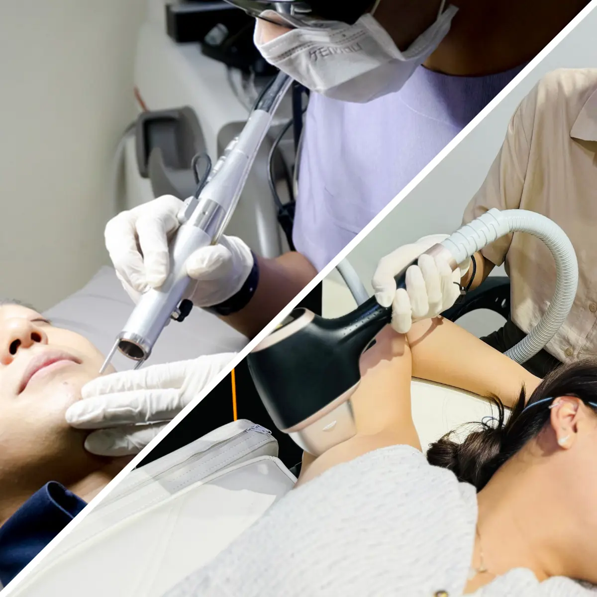 ヒゲやワキへのレーザー脱毛を行っているイメージ